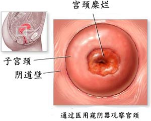 华阳红房子医生解析：怎样治疗宫颈糜烂？